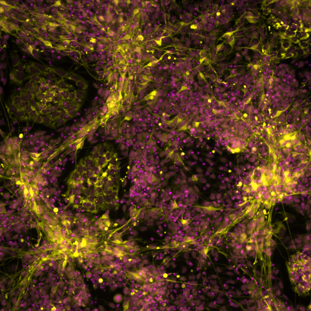 Mit fluoreszierenden Stoffen markierte, mutierte Stammzellen, die sich zu sympathischen Neuronen differenzieren. Copyright: Ingrid Saldana